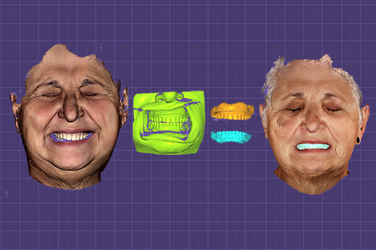 Mastering 2-Appointment Facially-Driven Dentures & Overdentures